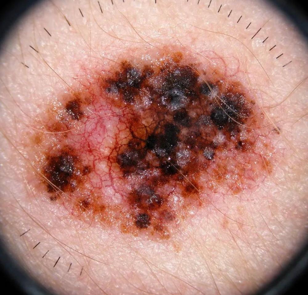 Злокачественные новообразования кожи