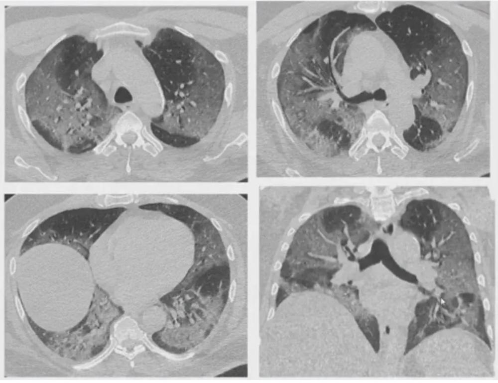 Зимой наряду с подъёмом заболеваемости ОРВИ и гриппом, отмечается рост заболеваемости вирусными пневмониями